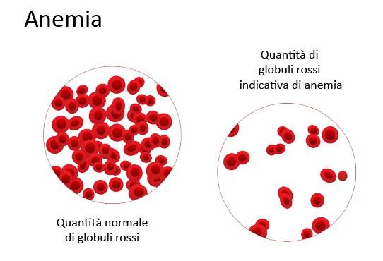 LE ANEMIE COME FAI AD AMMALARTI: la mancanza di ferro è la forma più comune di anemia, perché il ferro è necessario per formare L'emoglobina.