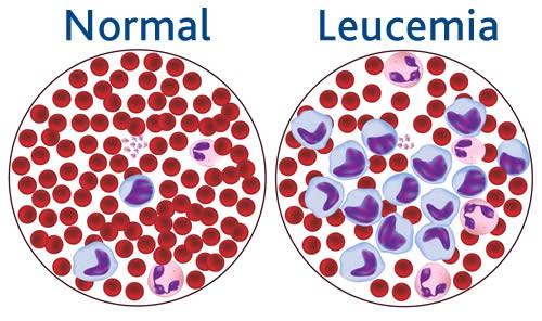 LA LEUCEMIA La leucemia si divide in due parti : CRONICA e ACUTA ossia in acuta, il numero di cellule tumorali aumenta più velocemente e la comparsa dei sintomi è precoce; nella leucemia cronica