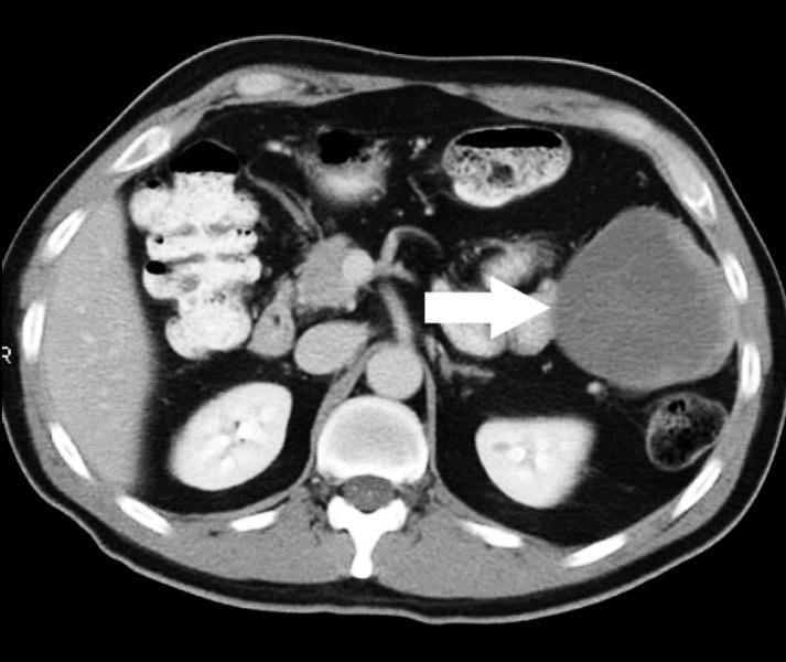 Immagine A: TAC di un GIST peritoneale recidivato: Immagine B: è una PET della stessa area, fatta contemporaneamente alla TAC, l area nera