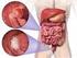 I tumori ereditari del colon-retto